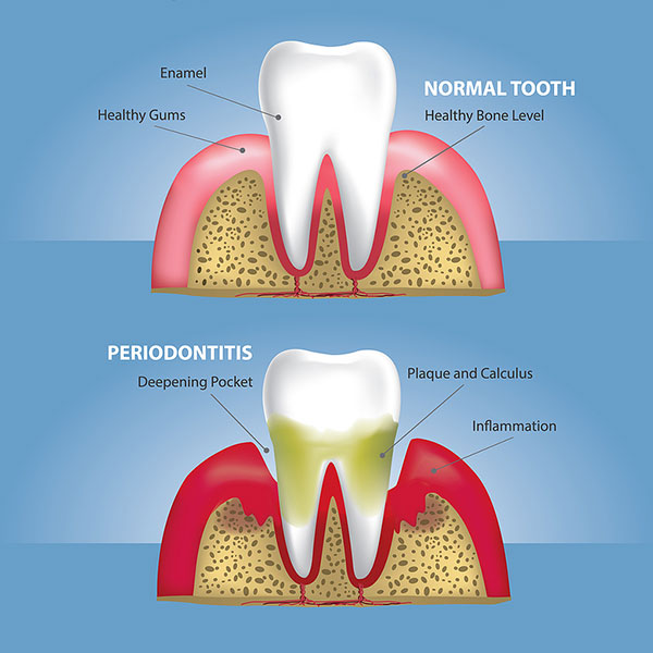 gum disease