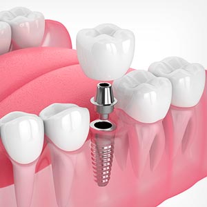 single dental implant